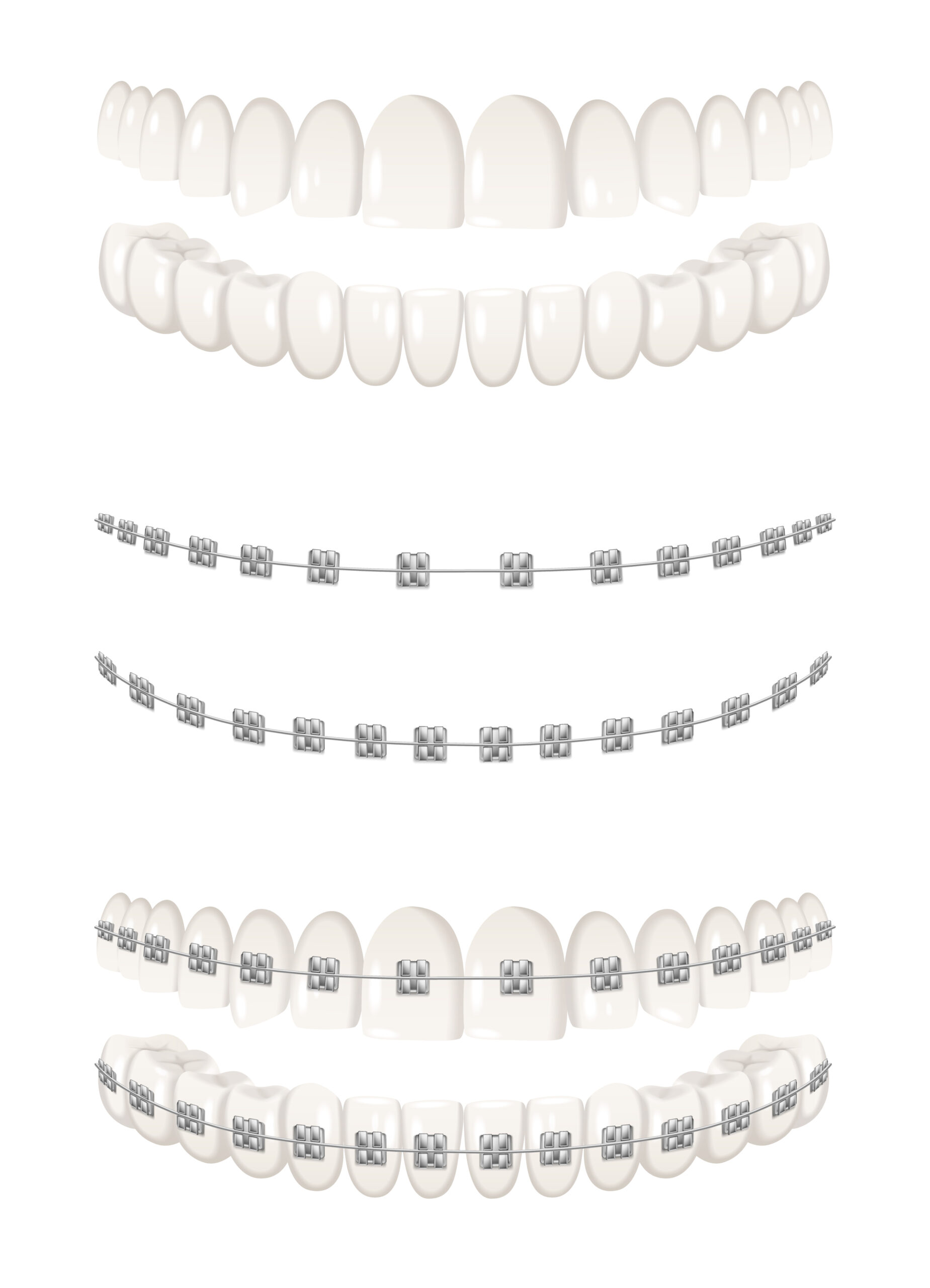 Teeth Braces Set