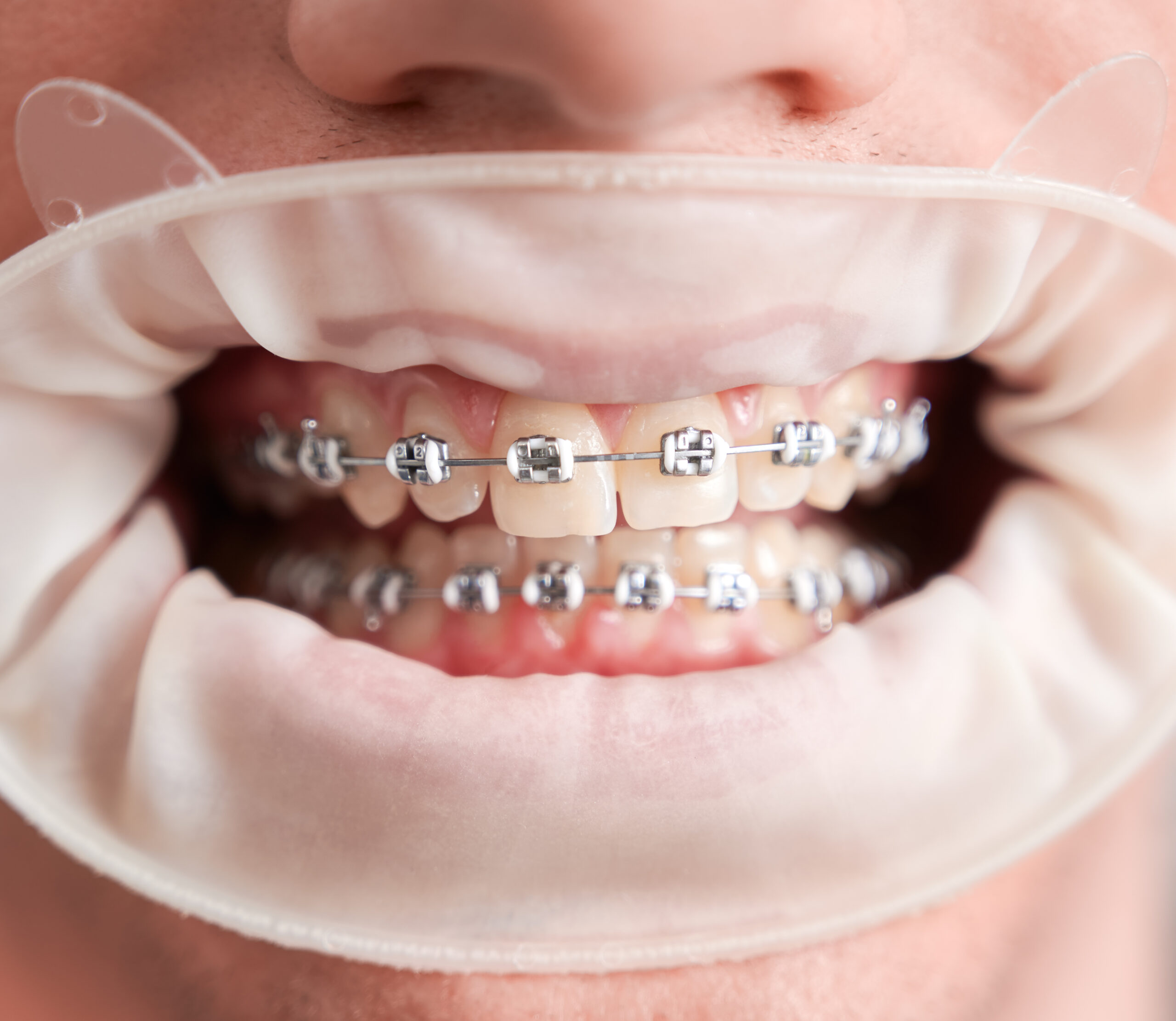 Male patient with cofferdam in mouth showing teeth with braces.